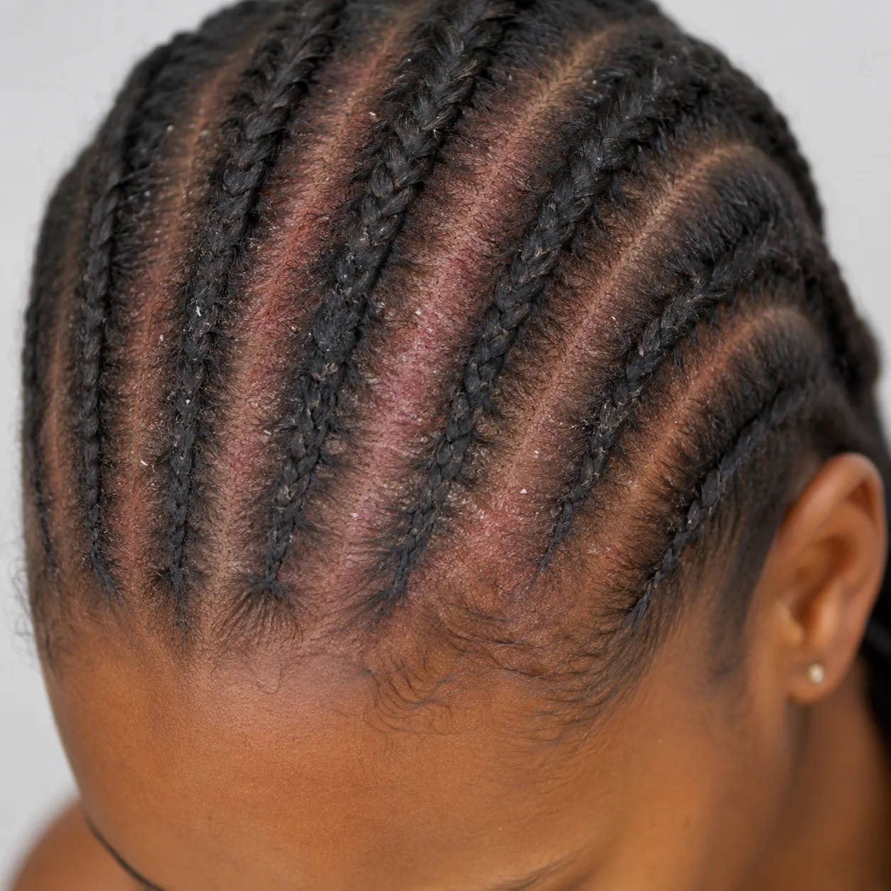 Braids Itchy Scalp
