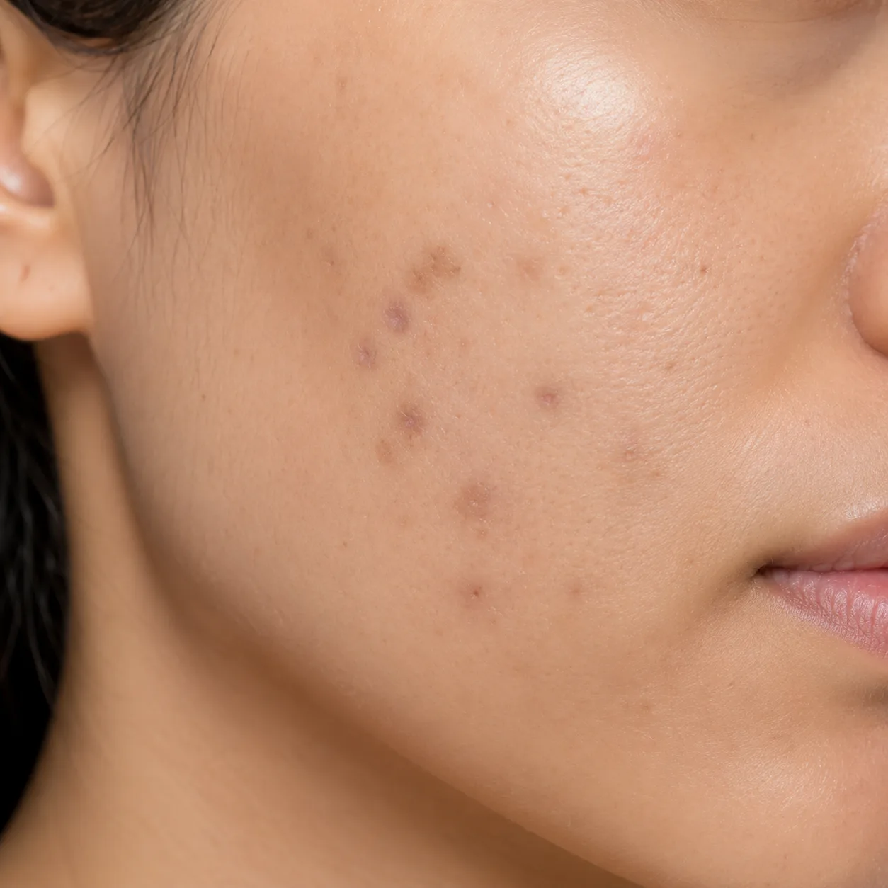 Dark Spots After Pimples
