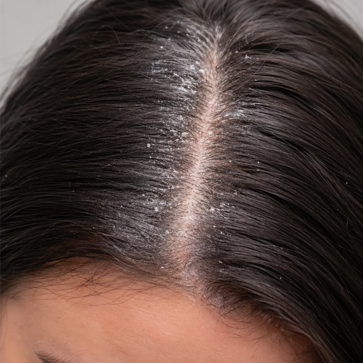 Scalp Flakes After Dry Shampoo