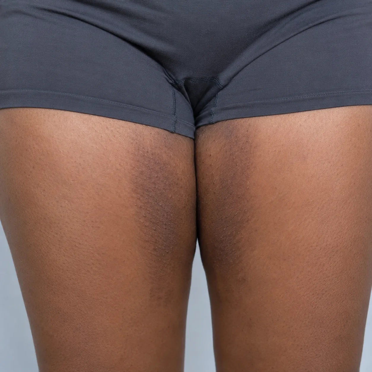 Thigh Chafing Leaves Dark Marks